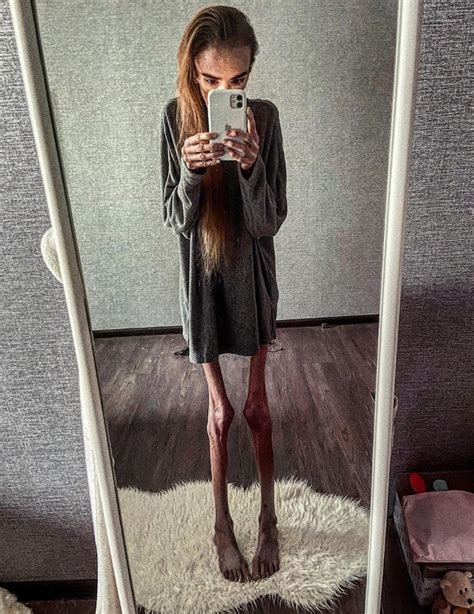 anorexic naked|333 Free Anorexia Porn Videos